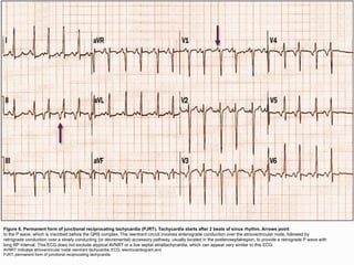 Taquiarritmias.cardiologiaclinica....... | PPTX