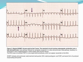 Taquiarritmias.cardiologiaclinica....... | PPTX
