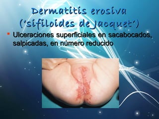 DDeerrmmaattiittiiss eerroossiivvaa 
((‘‘ssiiffiillooiiddeess ddee JJaaccqquueett’’) 
 UUllcceerraacciioonneess ssuuppeerrffiicciiaalleess eenn ssaaccaabbooccaaddooss,, 
ssaallppiiccaaddaass,, eenn nnúúmmeerroo rreedduucciiddoo 
 