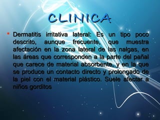 CCLLIINNIICCAA 
 DDeerrmmaattiittiiss iirrrriittaattiivvaa llaatteerraall:: EEss uunn ttiippoo ppooccoo 
ddeessccrriittoo,, aauunnqquuee ffrreeccuueennttee,, qquuee mmuueessttrraa 
aaffeeccttaacciióónn eenn llaa zzoonnaa llaatteerraall ddee llaass nnaallggaass,, eenn 
llaass áárreeaass qquuee ccoorrrreessppoonnddeenn aa llaa ppaarrttee ddeell ppaaññaall 
qquuee ccaarreeccee ddee mmaatteerriiaall aabbssoorrbbeennttee,, yy eenn llaa qquuee 
ssee pprroodduuccee uunn ccoonnttaaccttoo ddiirreeccttoo yy pprroolloonnggaaddoo ddee 
llaa ppiieell ccoonn eell mmaatteerriiaall pplláássttiiccoo.. SSuueellee aaffeeccttaarr aa 
nniiññooss ggoorrddiittooss 
 