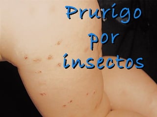 PPrruurriiggoo 
ppoorr 
iinnsseeccttooss 
 