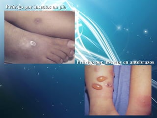 PPrrúúrriiggoo ppoorr iinnsseeccttooss eenn ppiiee 
PPrrúúrriiggoo ppoorr iinnsseeccttooss eenn aanntteebbrraazzooss 
 