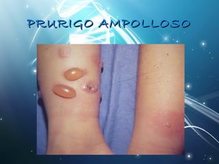 PPRRUURRIIGGOO AAMMPPOOLLLLOOSSOO 
 