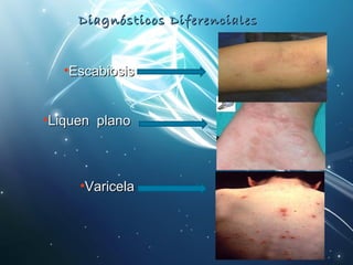 Diagnósticos DDiiffeerreenncciiaalleess 
•EEssccaabbiioossiiss 
•LLiiqquueenn ppllaannoo 
•VVaarriicceellaa 
 