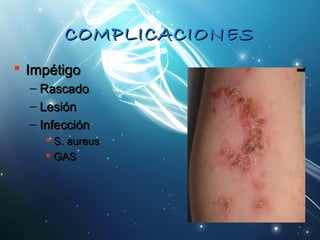 CCOOMMPPLLIICCAACCIIOONNEESS 
 IImmppééttiiggoo 
– RRaassccaaddoo 
– LLeessiióónn 
– IInnffeecccciióónn 
 SS.. aauurreeuuss 
 GGAASS 
 