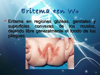 EErriitteemmaa «eenn WW» 
 EErriitteemmaa eenn rreeggiioonneess ggllúútteeaass,, ggeenniittaalleess yy 
ssuuppeerrffiicciieess ccoonnvveexxaass ddee llooss mmuussllooss,, 
ddeejjaannddoo lliibbrree ggeenneerraallmmeennttee eell ffoonnddoo ddee llooss 
pplliieegguueess 
 