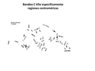 Técnica de Bandeo cromosómico 
Banda: parte de un cromosoma, que es claramente distinguible de los 
segmentos adyacentes, ...