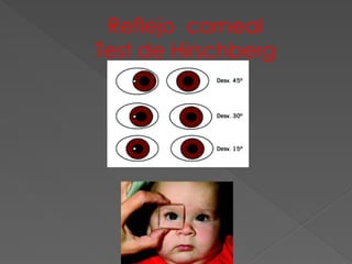 Reflejo corneal
Test de Hirschberg
 