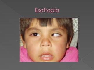 Esotropia
Acceso directo a DOWN sind.JPG.lnk
 