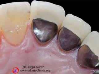 Preparación dentaria para coronas metal porcelana