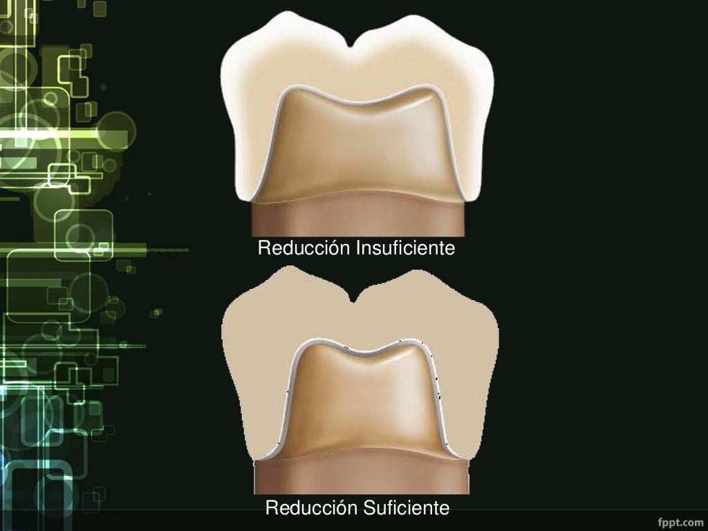 Preparación dentaria para coronas metal porcelana