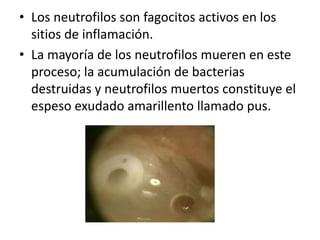 • Los neutrofilos son fagocitos activos en los
sitios de inflamación.
• La mayoría de los neutrofilos mueren en este
proceso; la acumulación de bacterias
destruidas y neutrofilos muertos constituye el
espeso exudado amarillento llamado pus.

 