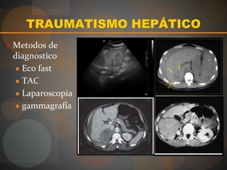TRAUMATISMO HEPÁTICO
● Metodos de
diagnostico
● Eco fast
● TAC
● Laparoscopia
● gammagrafía
 