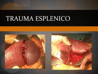 TRAUMA ESPLENICO
 