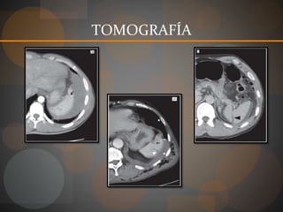 TOMOGRAFÍA
 