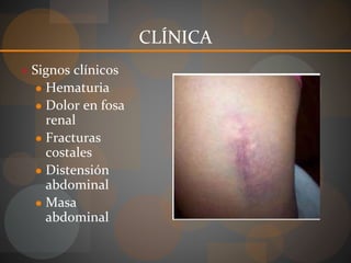 CLÍNICA
● Signos clínicos
● Hematuria
● Dolor en fosa
renal
● Fracturas
costales
● Distensión
abdominal
● Masa
abdominal
 