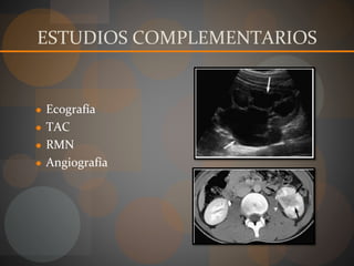 ESTUDIOS COMPLEMENTARIOS
● Ecografía
● TAC
● RMN
● Angiografía
 