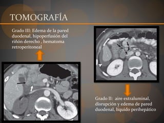 TOMOGRAFÍA
Grado II: aire extraluminal,
disrupción y edema de pared
duodenal, líquido perihepático
Grado III: Edema de la pared
duodenal, hipoperfusión del
riñón derecho , hematoma
retroperitoneal
 