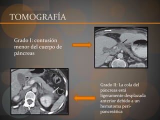 TOMOGRAFÍA
Grado I: contusión
menor del cuerpo de
páncreas
Grado II: La cola del
páncreas está
ligeramente desplazada
anterior debido a un
hematoma peri-
pancreática
 
