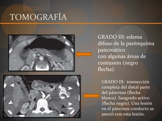 TOMOGRAFÍA
GRADO III: edema
difuso de la parénquima
pancreático
con algunas áreas de
contusión (negro
flecha).
GRADO III: transección
completa del distal parte
del páncreas (flecha
blanca). Sangrado activo
(flecha negro). Una lesión
en el páncreas conducto se
asoció con esta lesión.
 