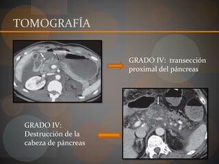 TOMOGRAFÍA
GRADO IV: transección
proximal del páncreas
GRADO IV:
Destrucción de la
cabeza de páncreas
 