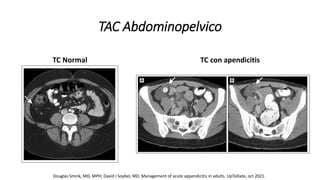 Clase Apendicitis PPTX Clase Apendicitis PPTX