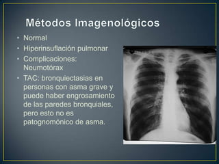 • Normal
• Hiperinsuflación pulmonar
• Complicaciones:
  Neumotórax
• TAC: bronquiectasias en
  personas con asma grave y
  puede haber engrosamiento
  de las paredes bronquiales,
  pero esto no es
  patognomónico de asma.
 
