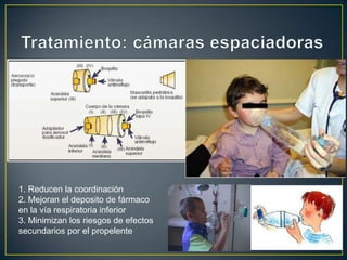1. Reducen la coordinación
2. Mejoran el deposito de fármaco
en la vía respiratoria inferior
3. Minimizan los riesgos de efectos
secundarios por el propelente
 