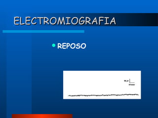 ELECTROMIOGRAFIA
 REPOSO

 