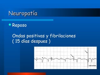 Neuropatía
 Reposo

Ondas positivas y fibrilaciones
( 15 días despues )

 