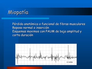 Miopatía
Pérdida anatómica o funcional de fibras musculares
Reposo normal o inserción
Esquemas maximos con PAUM de baja amplitud y
corta duración

 