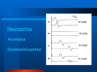Neuropatías
Axonales
Desmielinizantes

 