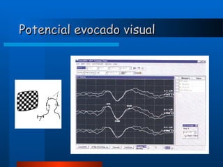 Potencial evocado visual

 