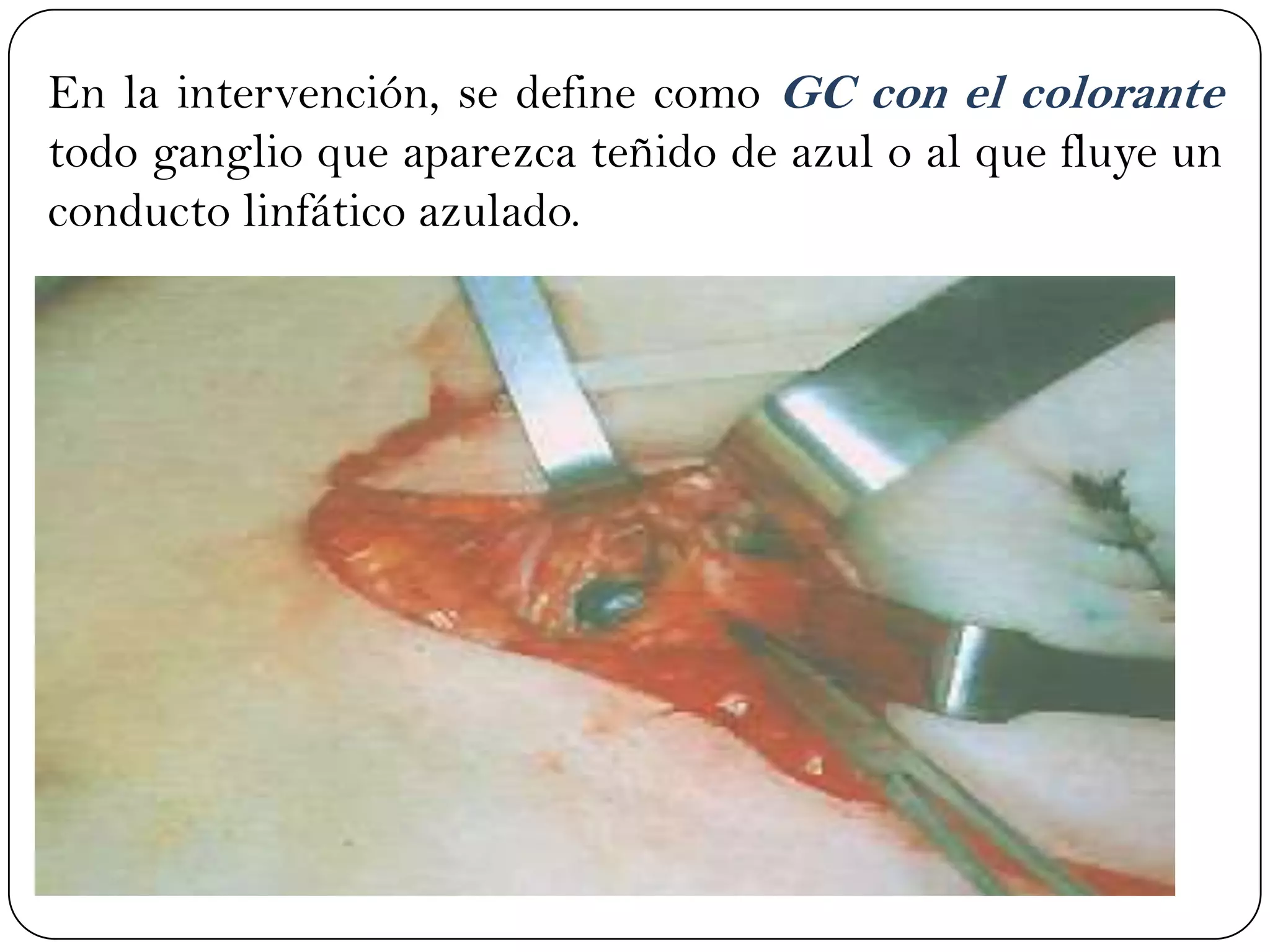 En la intervención, se define como GC con el colorante
todo ganglio que aparezca teñido de azul o al que fluye un
conducto linfático azulado.
 