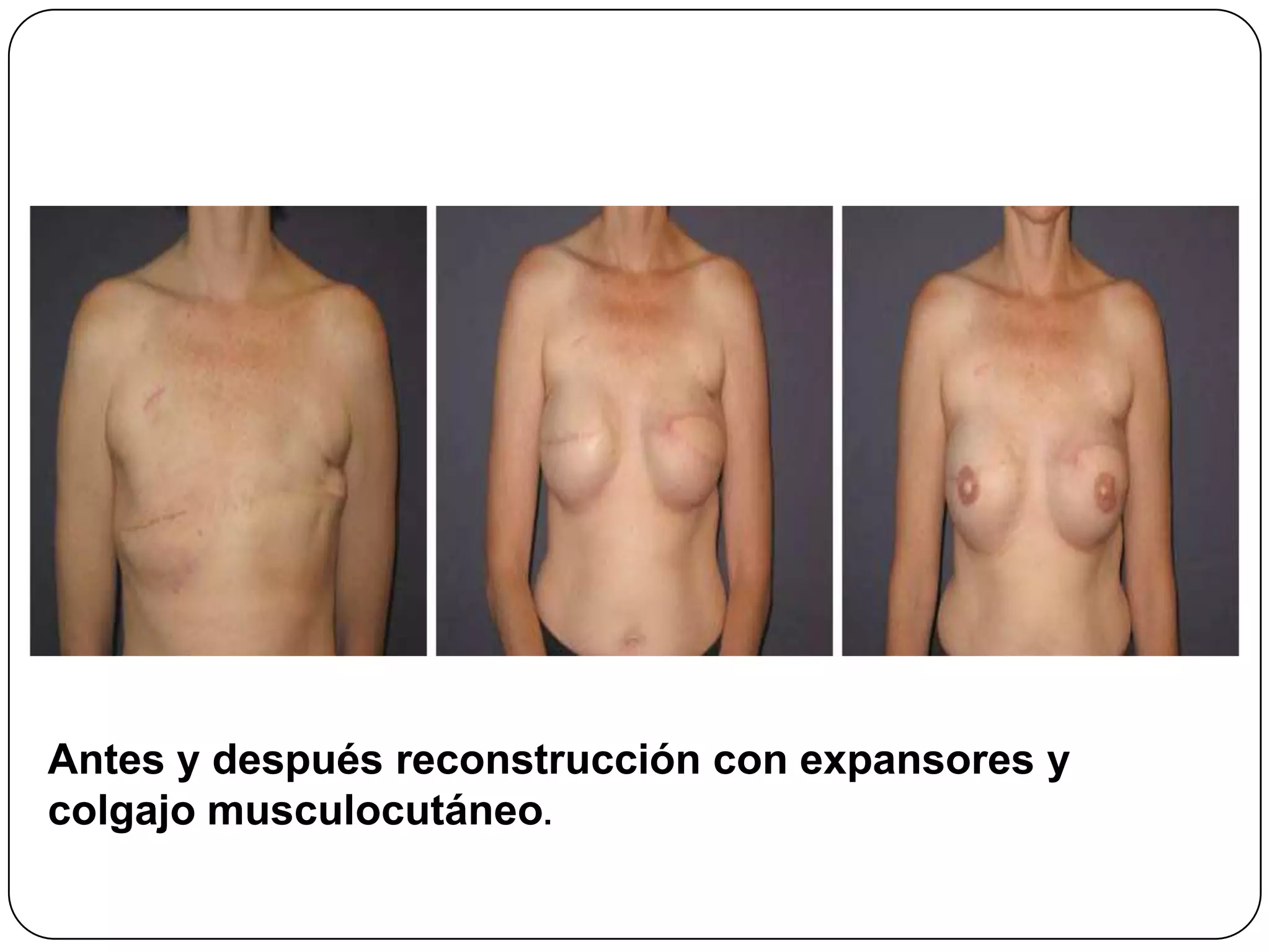 Antes y después reconstrucción con expansores y
colgajo musculocutáneo.
 
