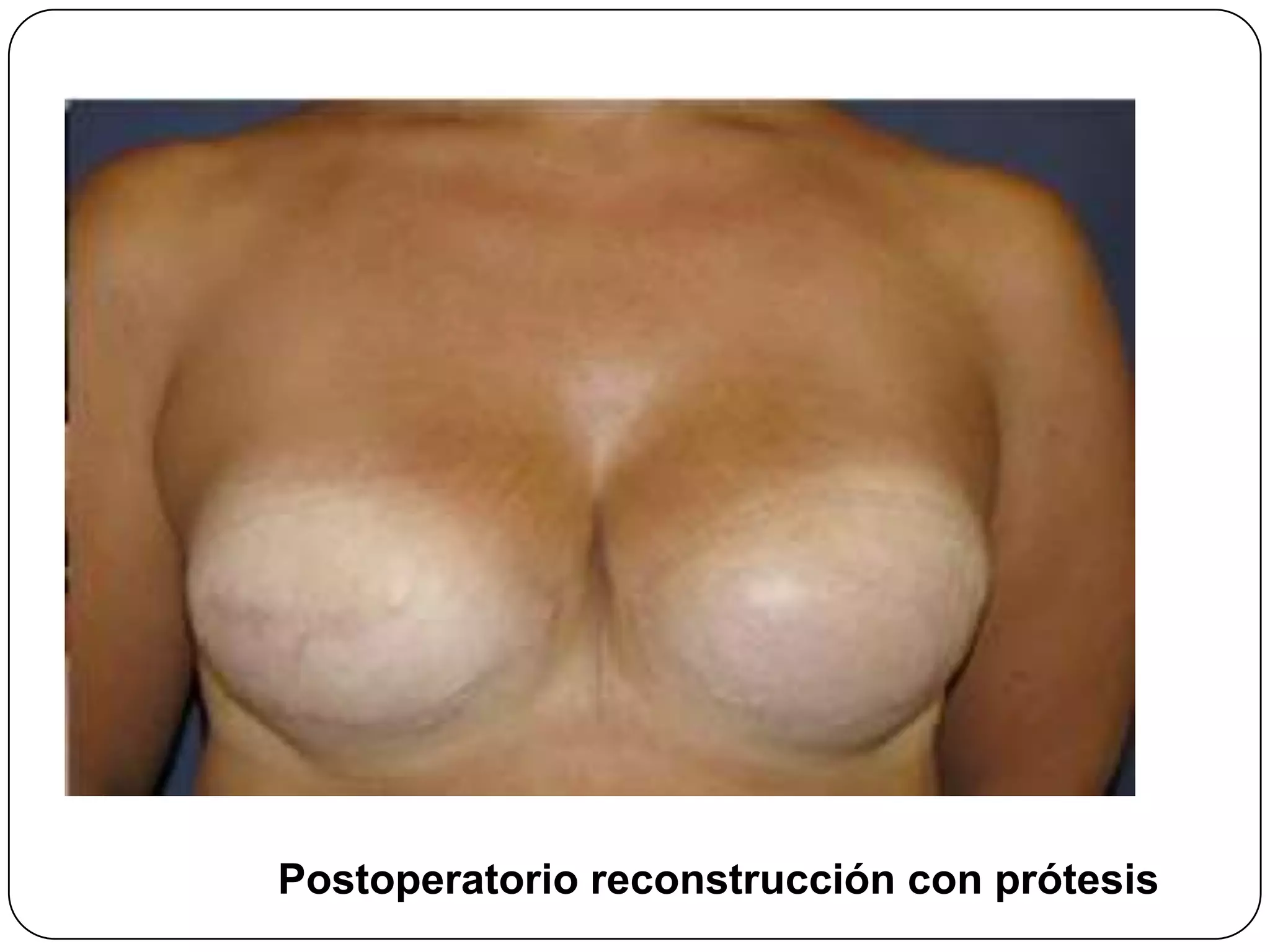 Postoperatorio reconstrucción con prótesis
 