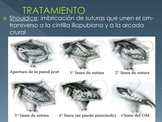 TRATAMIENTOShouldice: imbricación de suturas que unen el om-transverso a la cintilla iliopubiana y a la arcada crural