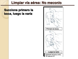 Limpiar vía aérea: No meconio

Succione primero la
boca, luego la nariz



                        Primero la boca. . .




                           Luego la nariz
                       Aspiración de boca y nariz,
                       “B” antes de “N”
 