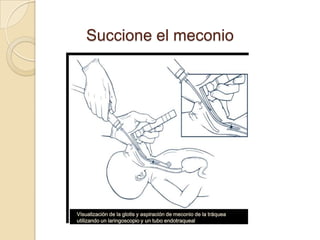 Succione el meconio




Visualización de la glotis y aspiración de meconio de la tráquea
utilizando un laringoscopio y un tubo endotraqueal
 