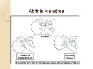 Abrir la vía aérea




                          Correcta




    Incorrecta                                      Incorrecta
 (hiperextensión)                                    (flexión)

Posiciones correctas o incorrectas de la cabeza para la reanimación
 