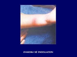 CHAGOMA DE INOCULACION
 