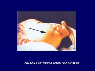 CHAGOMA DE INOCULACION SECUNDARIO
 