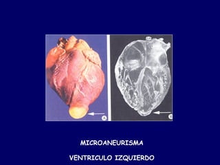 MICROANEURISMA

VENTRICULO IZQUIERDO
 