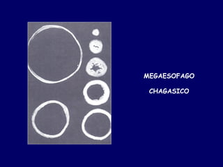 MEGAESOFAGO

 CHAGASICO
 