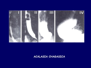 MEGAESOFAGO

                 CHAGASICO




ACALASIA CHAGASICA
 