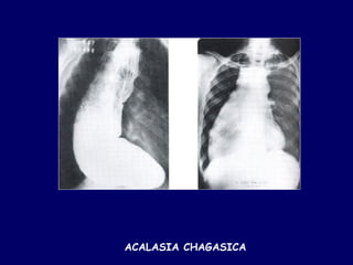 ACALASIA CHAGASICA
 