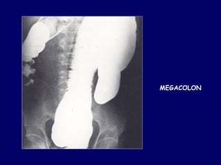 MEGACOLON
 