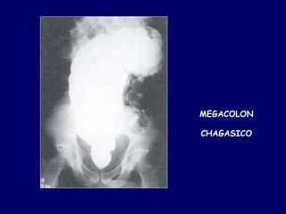 MEGACOLON

CHAGASICO
 