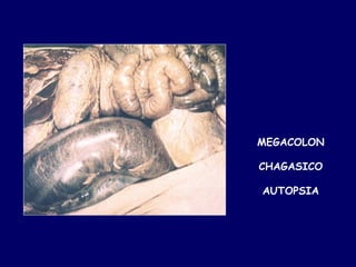 MEGACOLON

CHAGASICO

AUTOPSIA
 