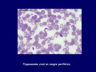 Trypanosoma cruzi en sangre periférica
 